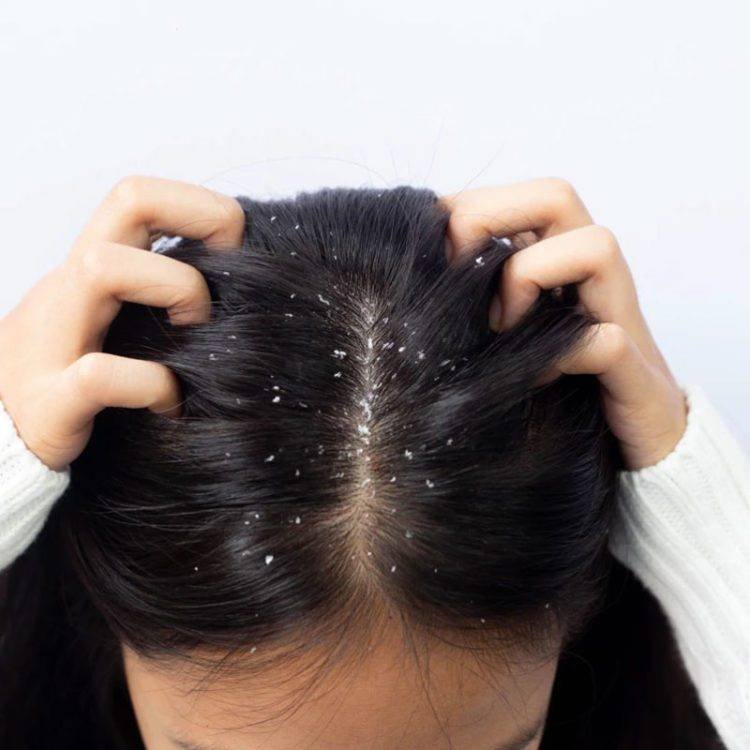 Causes of dandruff in women