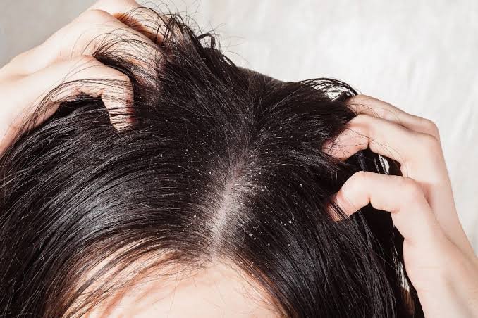 Cause of Dandruff Explained 