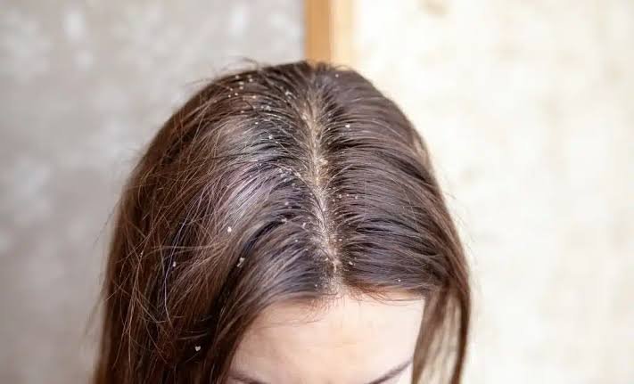 Hair care routine for oily scalp and dandruff 