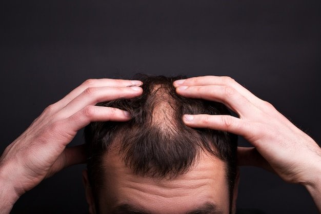 Causes of hair fall in men baldness 