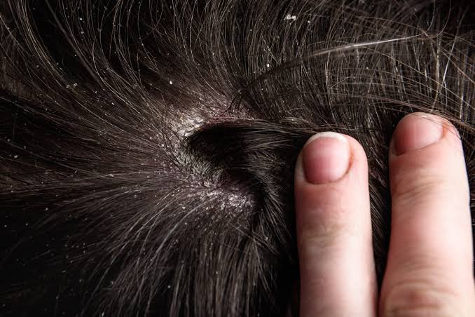 Dry scalp with dandruff 